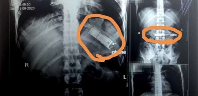 استخراج هاتف محمول من معدة مريض ابتلعه منذ عامين في أسيوط